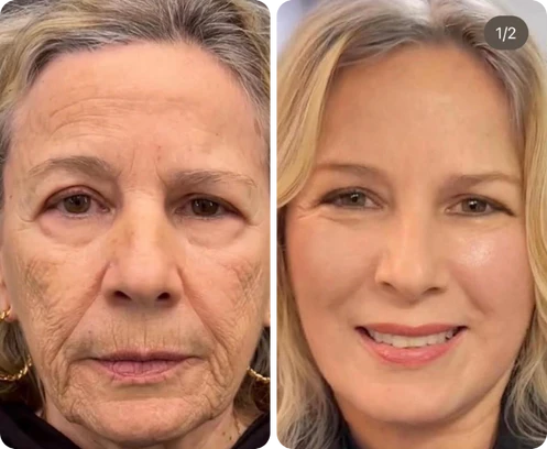 Antes e depois de Vera Rosa