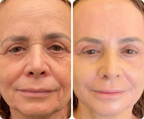 Antes e depois de Narcisa Valença