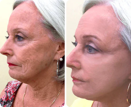 Antes e depois de Carmen Mendonça