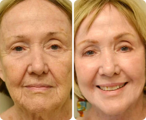Antes e depois de Luz Maria Santos