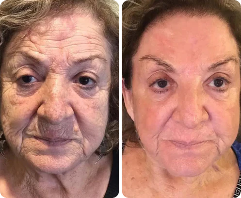 Antes e depois de Yolanda Trindade